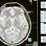 brain